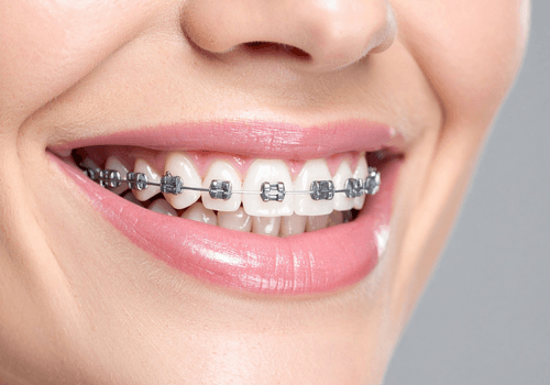 Braces