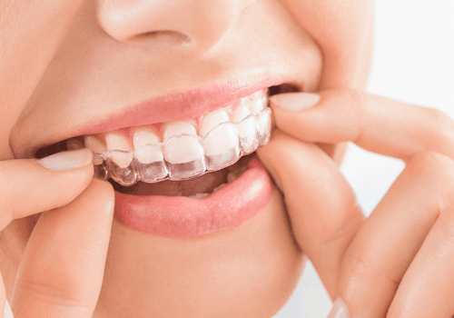 Aligners