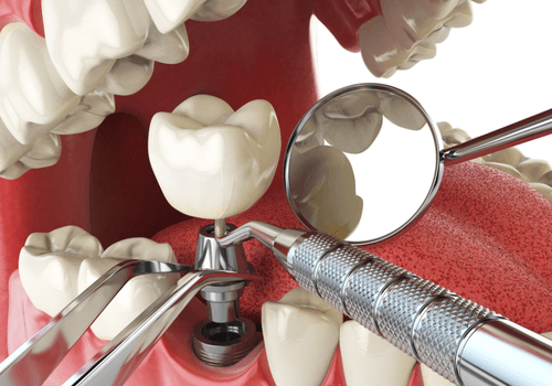Root Canal
