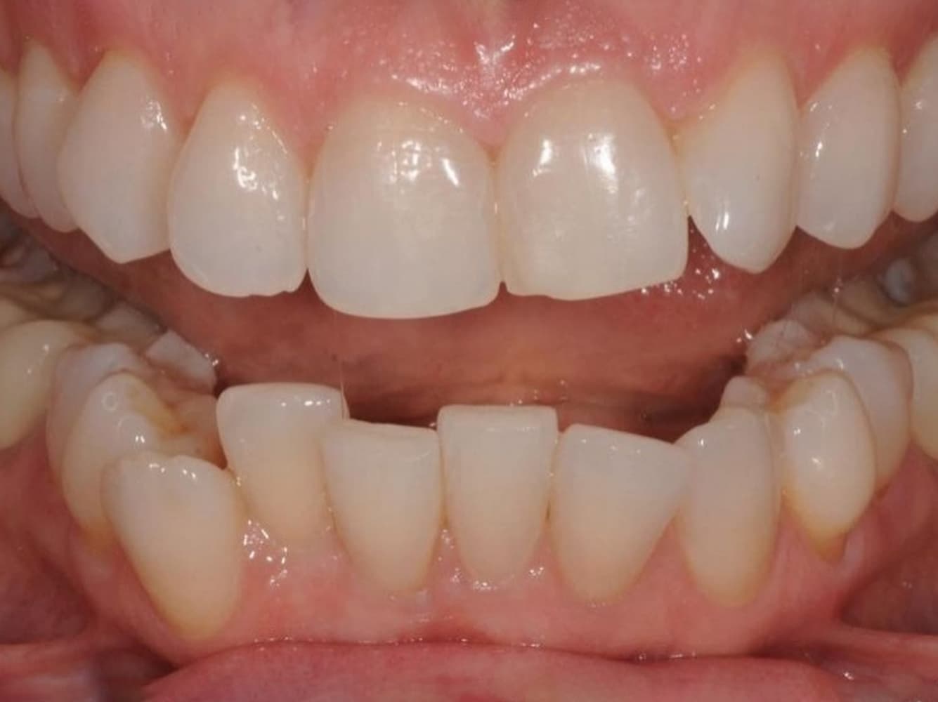 Aligners (before)