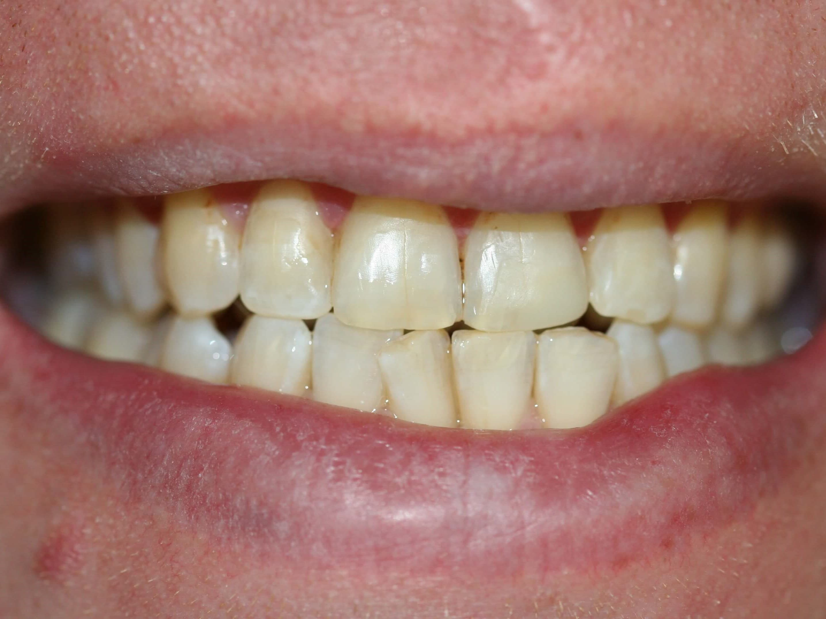 Crown / Bridge Rehabilitation (after)