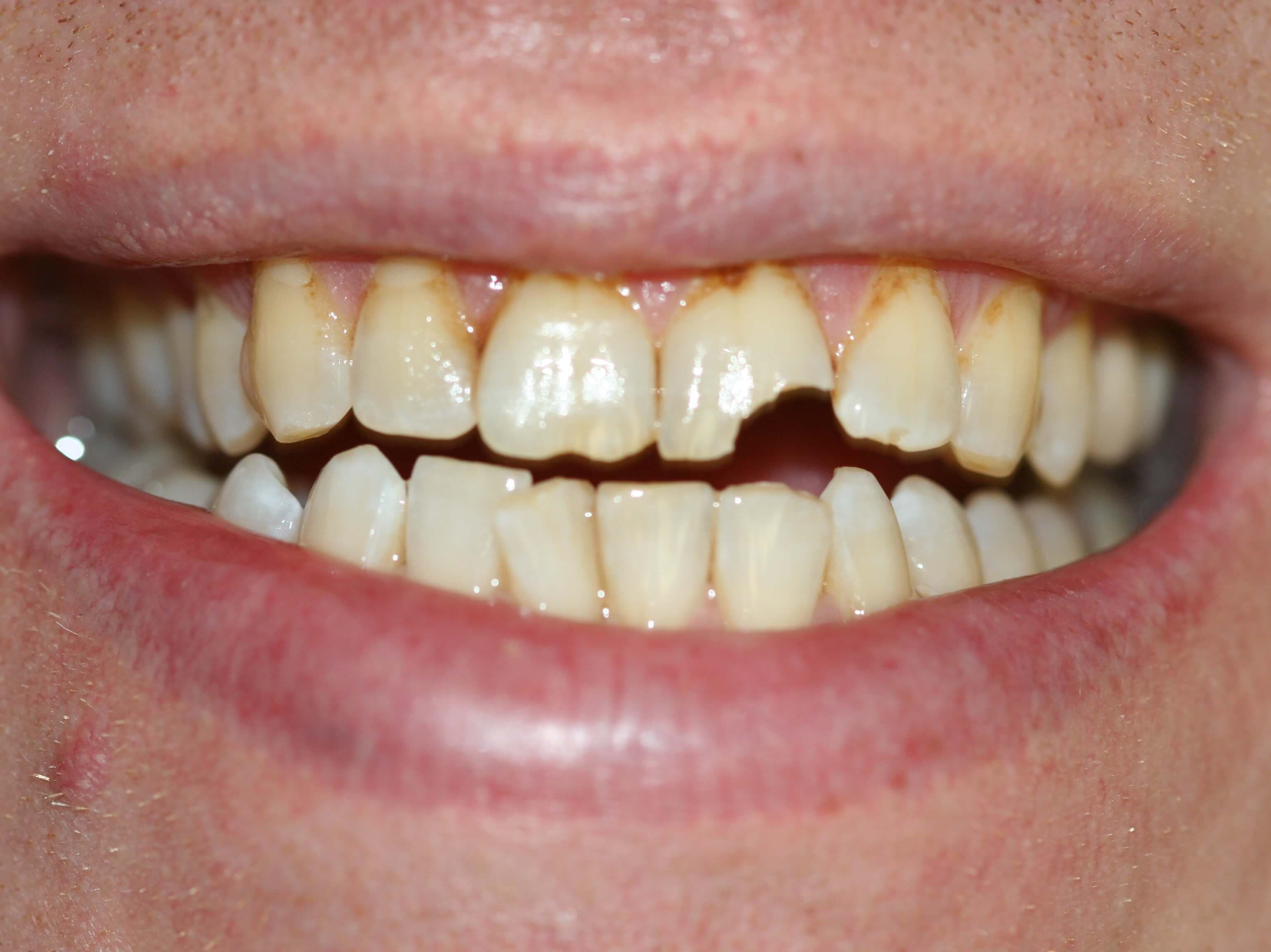 Crown / Bridge Rehabilitation (before)